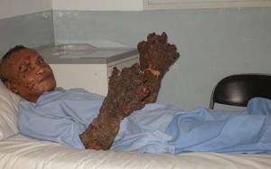 in-hospital-dede-koswara-tree-man