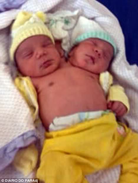 after-birth-abby-hensel-conjoined twins