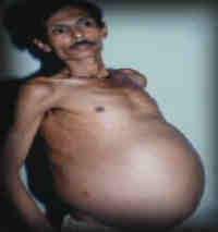 pregnant-sanjay-fetus in-fetu