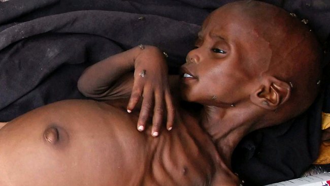 somalia-famine-affected-child