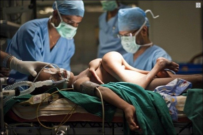 parasitic-twin-deepak-before-operation-under-anaesthesia