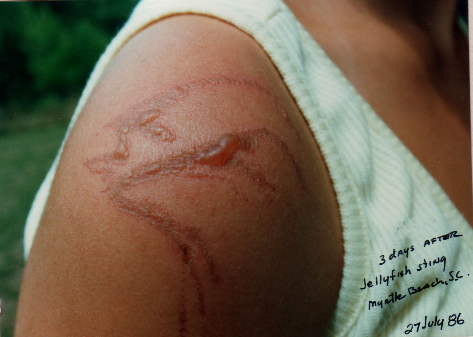 Jellyfish-Sting-causes-blister-in-skin